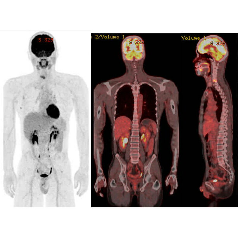 【ふるさと納税】佐久医療センター PET/CTがん検診 【佐久総合病院 PET/CTがん検診 がんの罹患数は多くのがんで増加 早期発見・早期治療ができれば転移や再発のリスクが少ないうちに治療ができる 治癒率（治る確率）が向上 長野県 佐久市 】 - 画像2